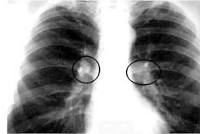 Код мкб туберкулез внутригрудных лимфатических узлов thumbnail