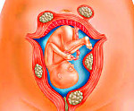 Беременность при миоме матки симптомы thumbnail