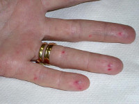Лечение синдром ослера рандю ослера thumbnail