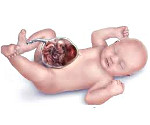 Грыжа кишечника у эмбриона thumbnail