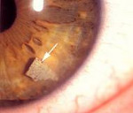 Лечение глаз после извлечения инородного тела thumbnail