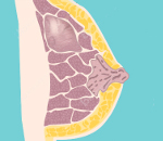 Доброкачественная опухоль грудной железы у женщин лечение thumbnail