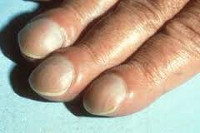 Деформированные ногти после обморожения thumbnail