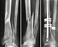 Перелом заднего края большеберцовой кости сроки лечения thumbnail