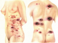 Грибовидный микоз и синдром сезари thumbnail