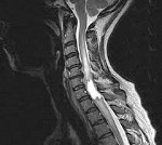 Интрамедуллярная опухоль спинного мозга поясничный отдел thumbnail