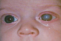 Синдром врожденной краснухи у детей thumbnail