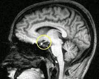 Гипотиреоидизм при синдроме шихана со снижением ттг проявляется thumbnail