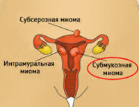 Что такое субмукозная миома тела матки thumbnail
