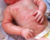 Пищевая аллергия проявление на коже ребенка thumbnail