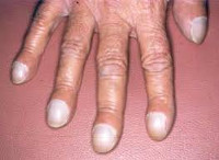 Синдром мари бамбергера гипертрофическая остеопатия thumbnail