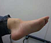 Голеностопный сустав: как лечить вывих и подвывих thumbnail