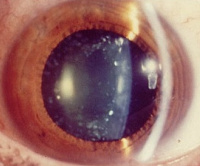 Искривление хрусталика глаза лечение thumbnail