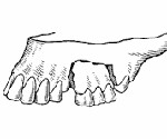 Перелом альвеолярного отростка зуба thumbnail