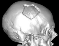 Перелом костей свода черепа с переходом на основание черепа thumbnail