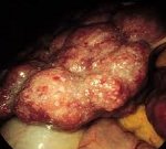 Аутоиммунный синдром при хроническом гепатите thumbnail