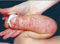 Папулезный дерматит у детей thumbnail