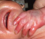 Сепсис кишечника у новорожденных последствия в развитии ребенка thumbnail