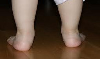 Вальгусная деформация стопы у детей