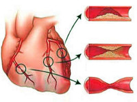 Ишемическая болезнь сердца симптомы течение лечение thumbnail