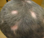 Симптомы выпадение волос у детей thumbnail