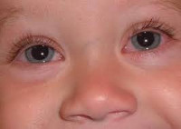 Аллергический конъюнктивит у детей thumbnail