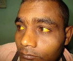 Синдром гемолитической желтухи и анемии thumbnail