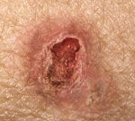 Возникновение рака кожи лица thumbnail