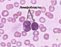 Для острого лимфобластного лейкоза характерны следующие синдромы thumbnail