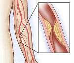 Атеросклероз синдром такаясу стеноз сонных артерий thumbnail