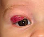 Кавернозная гемангиома глаза лечение thumbnail