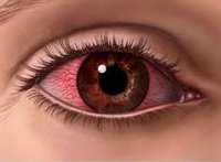 Аллергический кератит глаза лечение thumbnail