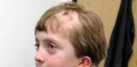 К кому обращаться при выпадении волос у ребенка thumbnail