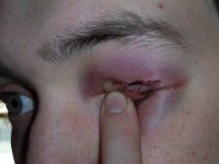 Лечение травмы глаза склеры thumbnail