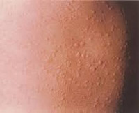 Признаки аллергии у взрослых крапивница thumbnail