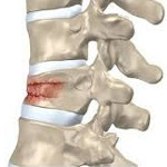 Падение на спину компрессионный перелом позвоночника thumbnail