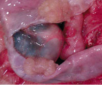 Серозная цистаденома левого яичника в менопаузе thumbnail