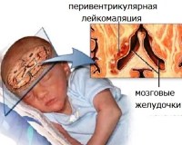 Умеренный перивентрикулярный отек у новорожденного что это thumbnail