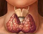 Лечение щитовидной железы токсический зоб thumbnail