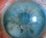 Буллезная кератопатия при глаукоме thumbnail