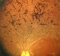 Пигментная абиотрофия сетчатки глаз thumbnail