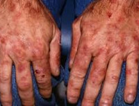 Поздняя кожная порфирия при гепатите thumbnail