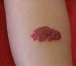 Гемангиома на ноге у детей и их лечение thumbnail