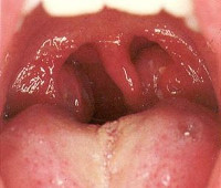 Симптомы при катаральной ангине thumbnail