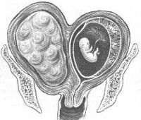 Миома матки при беремен симптомы thumbnail