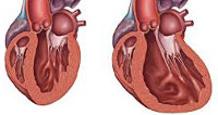 Как вылечить дилатационную кардиомиопатию thumbnail