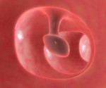 Полипы в мочевом пузыре симптомы и лечение thumbnail