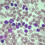 Показатели анализ крови при лимфоцитозе thumbnail