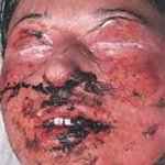 Токсико аллергический дерматит синдром лайелла thumbnail