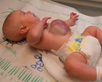 Эмбриональная грыжа пупочного канатика у детей thumbnail